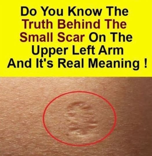 What Do Smallpox Vaccine Scars Look Like and Why Do They Form?