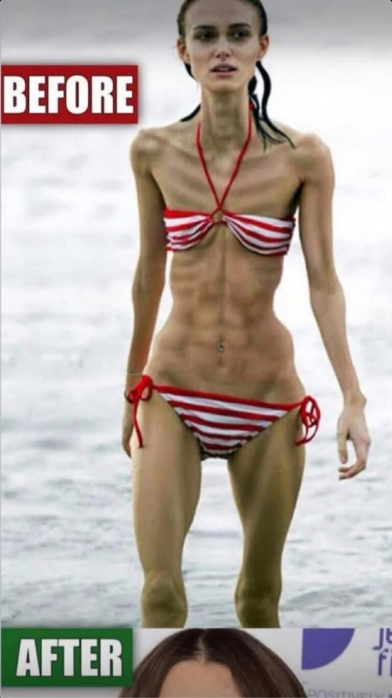 Their acne is severe!