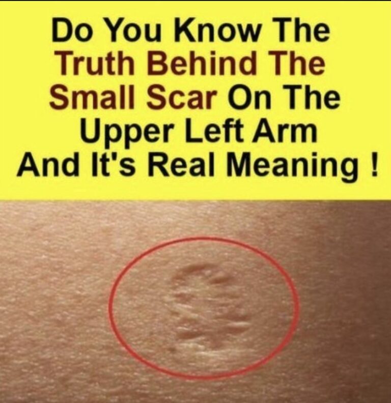 Smallpox vaccine scars: What they look like and why