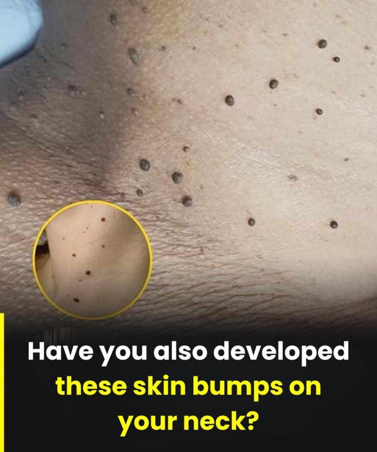 Why Do Skin Tags Suddenly Appear? 6 Common Causes Doctors Talk About